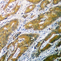 B4GALT1 Antibody - Immunohistochemical analysis of B4GALT1 staining in human colon cancer formalin fixed paraffin embedded tissue section. The section was pre-treated using heat mediated antigen retrieval with sodium citrate buffer (pH 6.0). The section was then incubated with the antibody at room temperature and detected with HRP and DAB as chromogen. The section was then counterstained with hematoxylin and mounted with DPX.