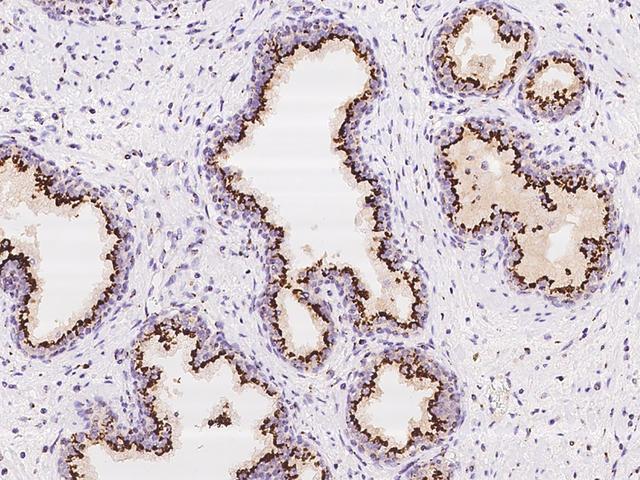 B4GALT1 Antibody - Immunochemical staining of human B4GALT1 in human prostate with rabbit polyclonal antibody at 1:1000 dilution, formalin-fixed paraffin embedded sections.
