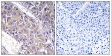 B4GALT3 Antibody - Immunohistochemistry analysis of paraffin-embedded human liver carcinoma tissue, using B4GALT3 Antibody. The picture on the right is blocked with the synthesized peptide.