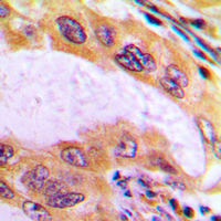 B4GALT3 Antibody - Immunohistochemical analysis of B4GALT3 staining in human liver cancer formalin fixed paraffin embedded tissue section. The section was pre-treated using heat mediated antigen retrieval with sodium citrate buffer (pH 6.0). The section was then incubated with the antibody at room temperature and detected using an HRP conjugated compact polymer system. DAB was used as the chromogen. The section was then counterstained with hematoxylin and mounted with DPX.
