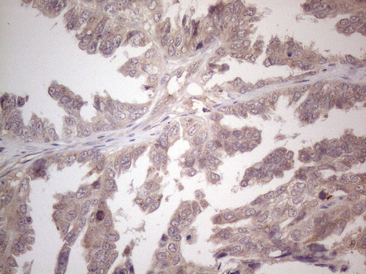 B4GALT4 Antibody - Immunohistochemical staining of paraffin-embedded Adenocarcinoma of Human ovary tissue using anti-B4GALT4 mouse monoclonal antibody. (Heat-induced epitope retrieval by 1mM EDTA in 10mM Tris buffer. (pH8.5) at 120°C for 3 min. (1:150)