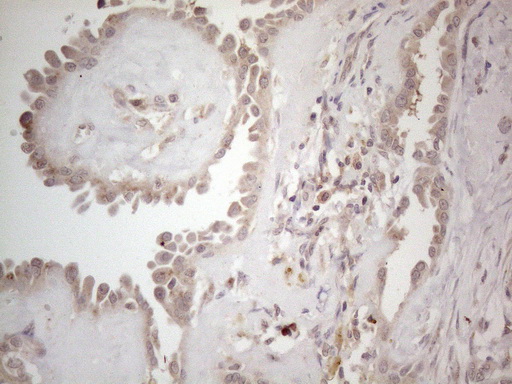 B4GALT4 Antibody - Immunohistochemical staining of paraffin-embedded Carcinoma of Human thyroid tissue using anti-B4GALT4 mouse monoclonal antibody. (Heat-induced epitope retrieval by 1mM EDTA in 10mM Tris buffer. (pH8.5) at 120°C for 3 min. (1:150)