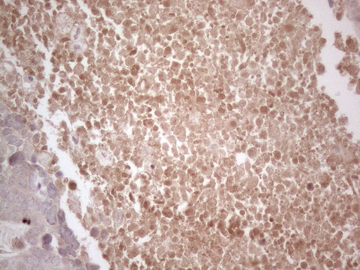 B4GALT4 Antibody - Immunohistochemical staining of paraffin-embedded Adenocarcinoma of Human endometrium tissue using anti-B4GALT4 mouse monoclonal antibody. (Heat-induced epitope retrieval by 1mM EDTA in 10mM Tris buffer. (pH8.5) at 120°C for 3 min. (1:150)