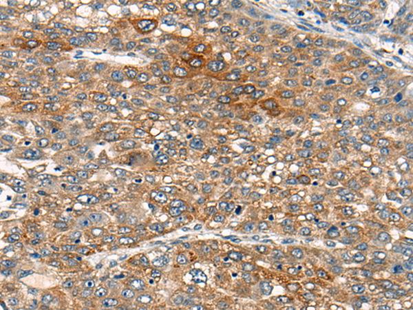 B4GAT1 / B3GNT1 Antibody - Immunohistochemistry of paraffin-embedded Human liver cancer tissue  using B4GAT1 Polyclonal Antibody at dilution of 1:110(×200)