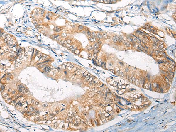 B4GAT1 / B3GNT1 Antibody - Immunohistochemistry of paraffin-embedded Human colorectal cancer tissue  using B4GAT1 Polyclonal Antibody at dilution of 1:110(×200)