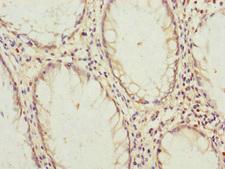 B9D2 Antibody - Immunohistochemistry of paraffin-embedded human colon cancer at dilution of 1:100