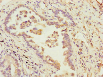 B9D2 Antibody - Immunohistochemistry of paraffin-embedded human lung cancer at dilution of 1:100