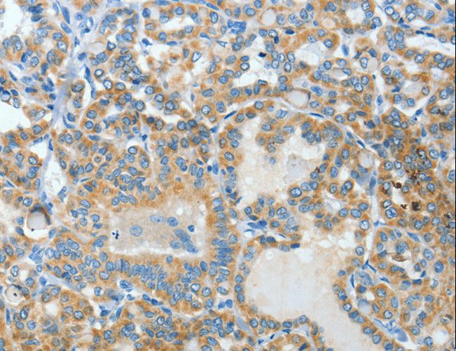 BAAT / BAT Antibody - Immunohistochemistry of paraffin-embedded Human thyroid cancer using BAAT Polyclonal Antibody at dilution of 1:30.