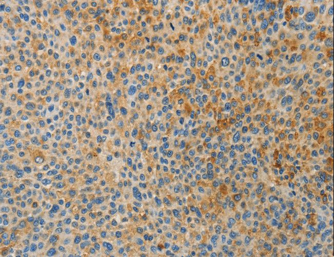 BAAT / BAT Antibody - Immunohistochemistry of paraffin-embedded Human liver cancer using BAAT Polyclonal Antibody at dilution of 1:30.