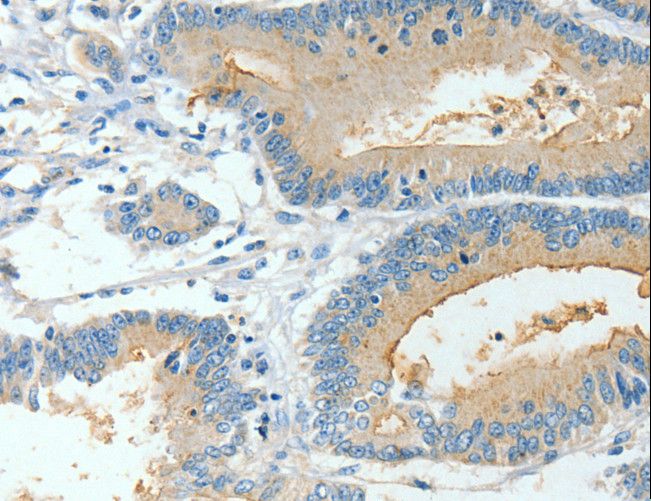 BAAT / BAT Antibody - Immunohistochemistry of paraffin-embedded Human colon cancer using BAAT Polyclonal Antibody at dilution of 1:30.