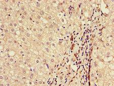 BAAT / BAT Antibody - Immunohistochemistry of paraffin-embedded human liver cancer using BAAT Antibody at dilution of 1:100