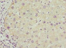 BAAT / BAT Antibody - Immunohistochemistry of paraffin-embedded human liver cancer at dilution 1:100
