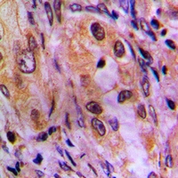 BABP / AKR1C2 Antibody - Immunohistochemical analysis of AKR1C2 staining in human lung cancer formalin fixed paraffin embedded tissue section. The section was pre-treated using heat mediated antigen retrieval with sodium citrate buffer (pH 6.0). The section was then incubated with the antibody at room temperature and detected with HRP and DAB as chromogen. The section was then counterstained with hematoxylin and mounted with DPX.