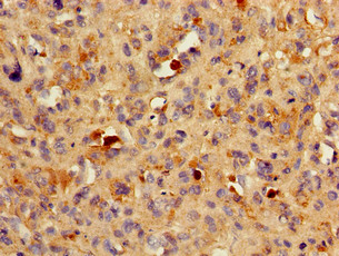 BACE1 / BACE Antibody - Immunohistochemistry of paraffin-embedded human melanoma cancer using BACE1 Antibody at dilution of 1:100