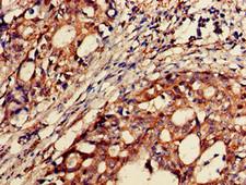 BACE2 Antibody - Immunohistochemistry of paraffin-embedded human gastric cancer using BACE2 Antibody at dilution of 1:100