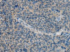 BACE2 Antibody - Immunohistochemistry of paraffin-embedded Human cervical cancer tissue  using BACE2 Polyclonal Antibody at dilution of 1:45(×200)
