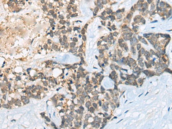 BACE2 Antibody - Immunohistochemistry of paraffin-embedded Human thyroid cancer tissue  using BACE2 Polyclonal Antibody at dilution of 1:45(×200)