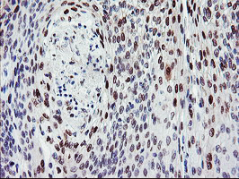 BACH1 Antibody - IHC of paraffin-embedded Carcinoma of Human bladder tissue using anti-BACH1 mouse monoclonal antibody.