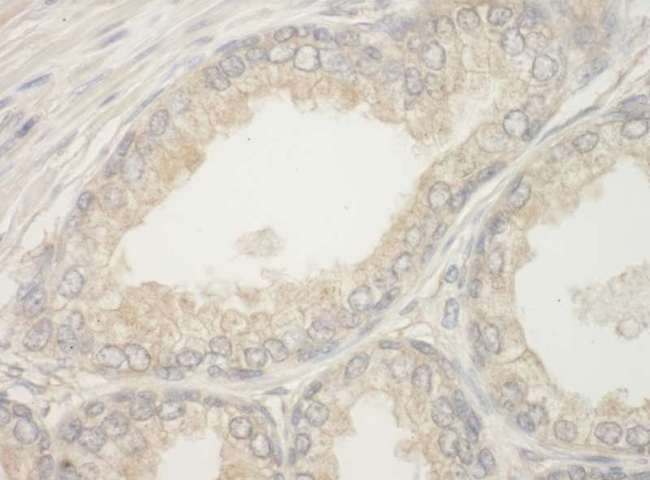 BAD Antibody - Detection of Human BAD by Immunohistochemistry. Sample: FFPE section of human prostate carcinoma. Antibody: Affinity purified rabbit anti-BAD used at a dilution of 1:500.