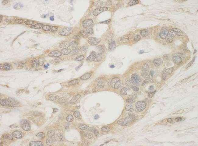 BAD Antibody - Detection of Human BAD by Immunohistochemistry. Sample: FFPE section of human ovarian carcinoma. Antibody: Affinity purified rabbit anti-BAD used at a dilution of 1:500.