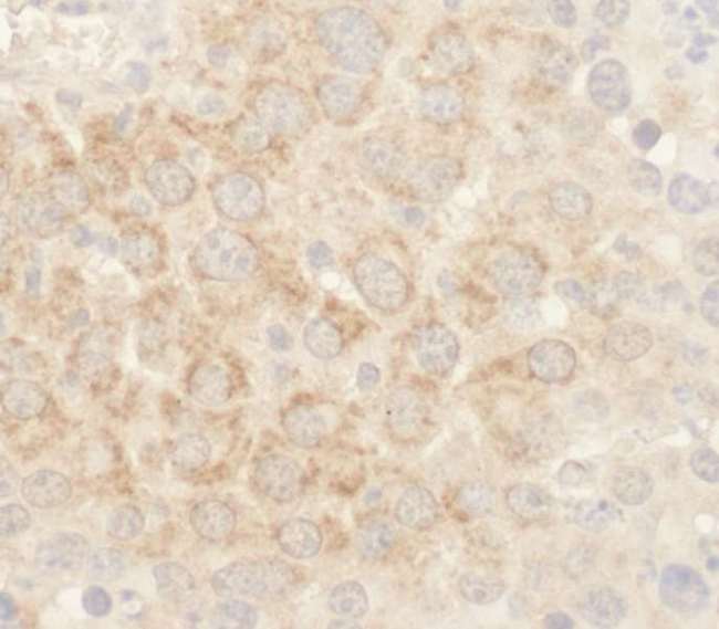 BAD Antibody - Detection of Mouse BAD by Immunohistochemistry. Sample: FFPE section of mouse renal cell carcinoma. Antibody: Affinity purified rabbit anti-BAD used at a dilution of 1:100.