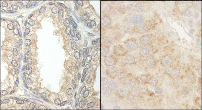 BAD Antibody - Detection of Human and Mouse BAD by Immunohistochemistry. Sample: FFPE section of human prostate carcinoma (left) and mouse renal cell carcinoma (right). Antibody: Affinity purified rabbit anti-BAD used at a dilution of 1:5000 (0.2 ug/ml) and 1:1000 (1 ug/ml).