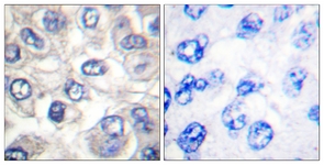 BAD Antibody - IHC of paraffin-embedded human breast carcinoma tissue, using BAD (Cleaved-Asp71) Antibody. The picture on the right is treated with the synthesized peptide.