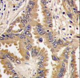 BAD Antibody - Formalin-fixed and paraffin-embedded human lung carcinoma tissue reacted with Bad antibody , which was peroxidase-conjugated to the secondary antibody, followed by DAB staining. This data demonstrates the use of this antibody for immunohistochemistry; clinical relevance has not been evaluated.