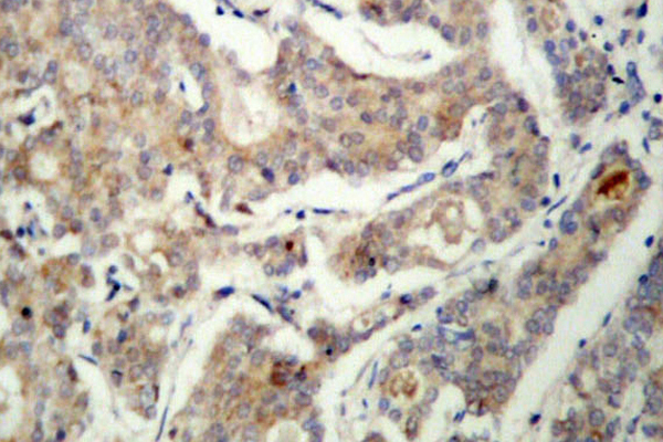 BAD Antibody - IHC of BAD (R149) pAb in paraffin-embedded human breast carcinoma tissue.