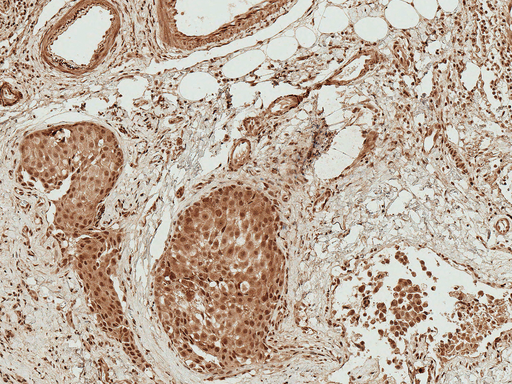 BAD Antibody - Immunohistochemistry analysis using Rabbit Anti-BAD Polyclonal Antibody. Tissue: Breast Cancer. Species: Human. Fixation: Formalin Fixed Paraffin-Embedded. Primary Antibody: Rabbit Anti-BAD Polyclonal Antibody  at 1:50 for 30 min at RT. Counterstain: Hematoxylin. Magnification: 10X. HRP-DAB Detection.