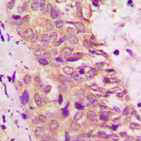BAD Antibody - Immunohistochemical analysis of BAD staining in human prostate cancer formalin fixed paraffin embedded tissue section. The section was pre-treated using heat mediated antigen retrieval with sodium citrate buffer (pH 6.0). The section was then incubated with the antibody at room temperature and detected using an HRP-conjugated compact polymer system. DAB was used as the chromogen. The section was then counterstained with hematoxylin and mounted with DPX.