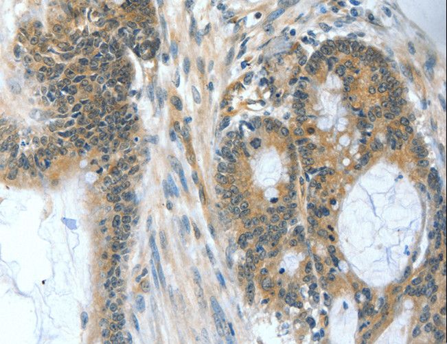 BAD Antibody - Immunohistochemistry of paraffin-embedded Human esophagus cancer using BAD Polyclonal Antibody at dilution of 1:60.