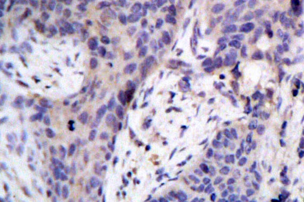 BAD Antibody - IHC of BAD(F130) pAb in paraffin-embedded human breast carcinoma tissue.