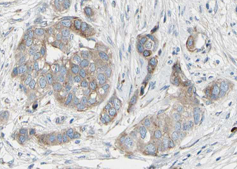 BAD Antibody - 1:100 staining human breast carcinoma tissue by IHC-P. The tissue was formaldehyde fixed and a heat mediated antigen retrieval step in citrate buffer was performed. The tissue was then blocked and incubated with the antibody for 1.5 hours at 22°C. An HRP conjugated goat anti-rabbit antibody was used as the secondary.