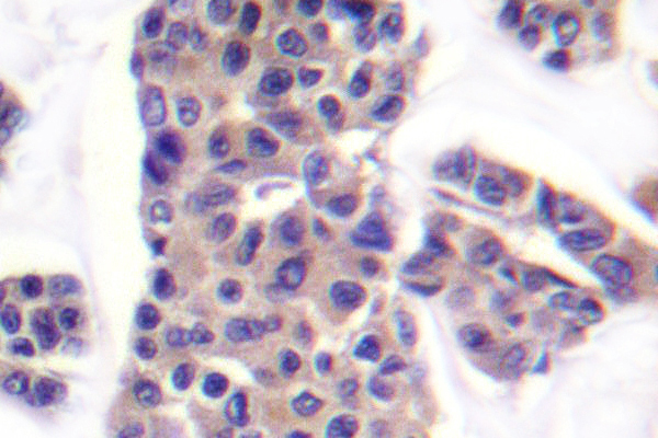 BAD Antibody - IHC of p-Bad (S91) pAb in paraffin-embedded human breast carcinoma tissue.