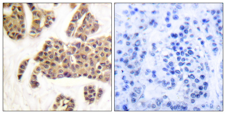BAD Antibody - Immunohistochemistry analysis of paraffin-embedded human breast carcinoma, using BAD (Phospho-Ser91/128) Antibody. The picture on the right is blocked with the phospho peptide.