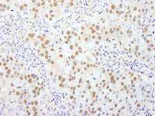 BAF53 / ACTL6A Antibody - Detection of Human BAF53A by Immunohistochemistry. Sample: FFPE section of human breast carcinoma. Antibody: Affinity purified rabbit anti-BAF53A used at a dilution of 1:250.