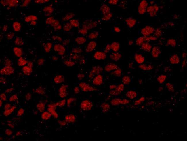 BAF53 / ACTL6A Antibody - Detection of Human BAF53A by Immunofluorescence. Sample: FFPE section of human breast carcinoma. Antibody: Affinity purified rabbit anti-BAF53A used at a dilution of 1:100. Detection: Red-fluorescent goat anti-rabbit IgG highly cross-adsorbed Antibody used at a dilution of 1:100.