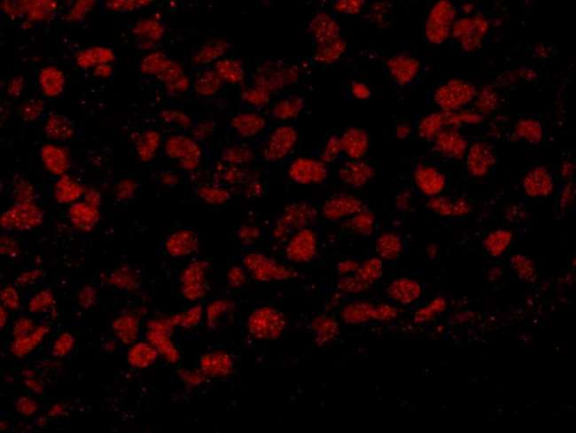 BAF53 / ACTL6A Antibody - Detection of human BAF53A by immunohistochemistry. Sample: FFPE section of human breast carcinoma. Antibody: Affinity purified rabbit anti-BAF53A used at a dilution of 1:100. Detection: Red-fluorescent goat anti-rabbit IgG highly cross-adsorbed Antibody used at a dilution of 1:100.