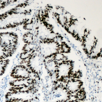 BAF53 / ACTL6A Antibody - Immunohistochemical analysis of BAF53A staining in human colon cancer formalin fixed paraffin embedded tissue section. The section was pre-treated using heat mediated antigen retrieval with sodium citrate buffer (pH 6.0). The section was then incubated with the antibody at room temperature and detected using an HRP conjugated compact polymer system. DAB was used as the chromogen. The section was then counterstained with hematoxylin and mounted with DPX.