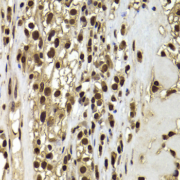 BAF53B / ACTL6B Antibody - Immunohistochemistry of paraffin-embedded human kidney cancer tissue.