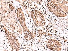 BAF53B / ACTL6B Antibody - Immunohistochemistry of paraffin-embedded Human esophagus cancer tissue  using ACTL6B Polyclonal Antibody at dilution of 1:100(×200)