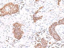 BAF53B / ACTL6B Antibody - Immunohistochemistry of paraffin-embedded Human esophagus cancer tissue  using ACTL6B Polyclonal Antibody at dilution of 1:55(×200)