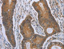 BAFF Receptor / CD268 Antibody - Immunohistochemistry of paraffin-embedded Human colon cancer using TNFRSF13C Polyclonal Antibody at dilution of 1:40.