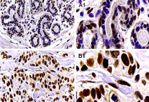 BAG1 / BAG-1 Antibody - Formalin-fixed, paraffin-embedded human breast tissue stained for BAG-1 expression using Polyclonal Antibody to BAG-1 at 1:2000. A. normal breast epithelium. B. breast cancer. A1 and B1 are high magnifications from A and B, respectively. Hematoxylin-Eosin counterstain.
