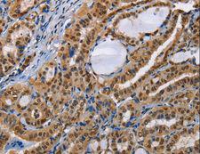 BAG1 / BAG-1 Antibody - Immunohistochemistry of paraffin-embedded Human thyroid cancer using BAG1 Polyclonal Antibody at dilution of 1:40.