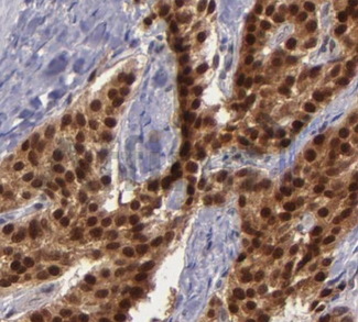 BAG1 / BAG-1 Antibody - 1/100 staining human breast  tissue by IHC-P. The sample was formaldehyde fixed and a heat mediated antigen retrieval step in citrate buffer was performed. The sample was then blocked and incubated with the antibody for 1.5 hours at 22°C. An HRP conjugated goat anti-rabbit antibody was used as the secondary antibody.