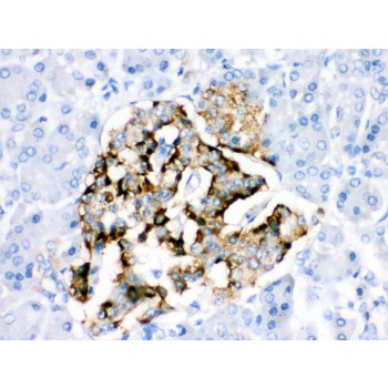 BAG2 Antibody - BAG2 antibody IHC-paraffin. IHC(P): Human Pancreatic Cancer Tissue.