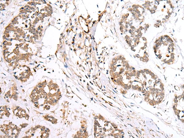 BAG2 Antibody - Immunohistochemistry of paraffin-embedded Human esophagus cancer tissue  using BAG2 Polyclonal Antibody at dilution of 1:40(×200)