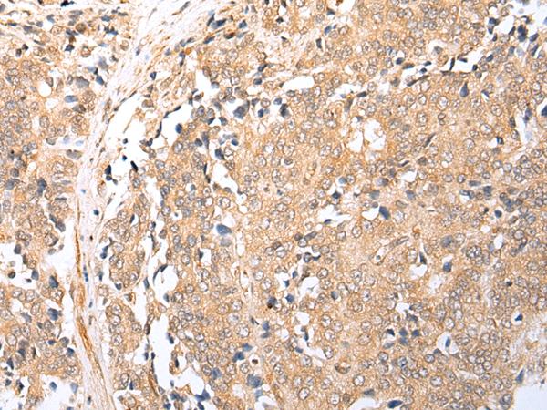 BAG2 Antibody - Immunohistochemistry of paraffin-embedded Human prost at e cancer tissue  using BAG2 Polyclonal Antibody at dilution of 1:25(×200)